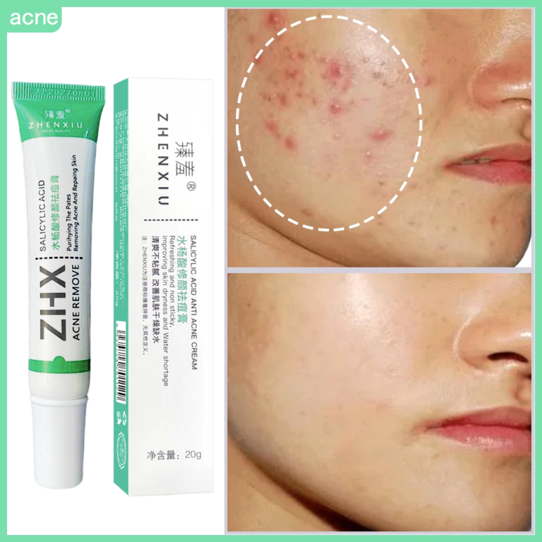 Ácido Salicílico Acne Creme Remover Cravo Controle De Óleo Anti-Tratamento Reparação Espinha — achadinho de skincare que vale a pena